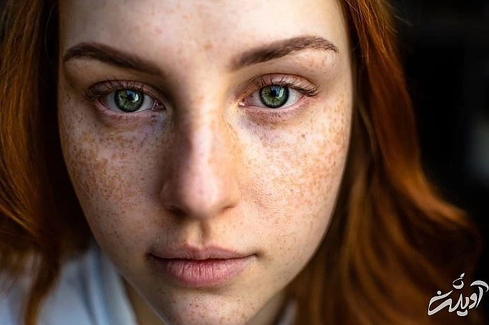 لکه های پوستی از مضرات لیف زدن صورت لکه های پوستی